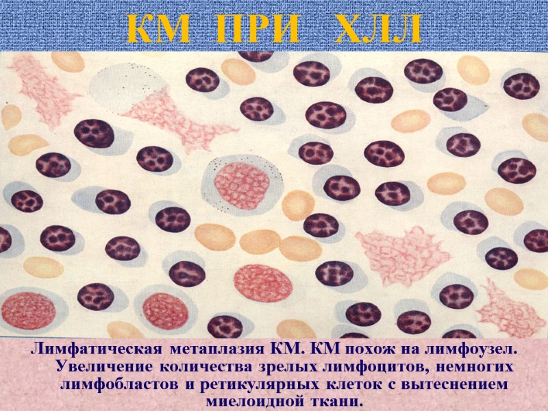 КМ  ПРИ   ХЛЛ Лимфатическая метаплазия КМ. КМ похож на лимфоузел. Увеличение